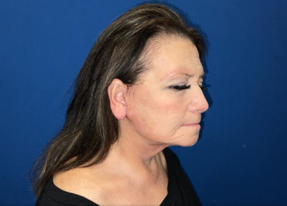Facelift: Case 4 - After