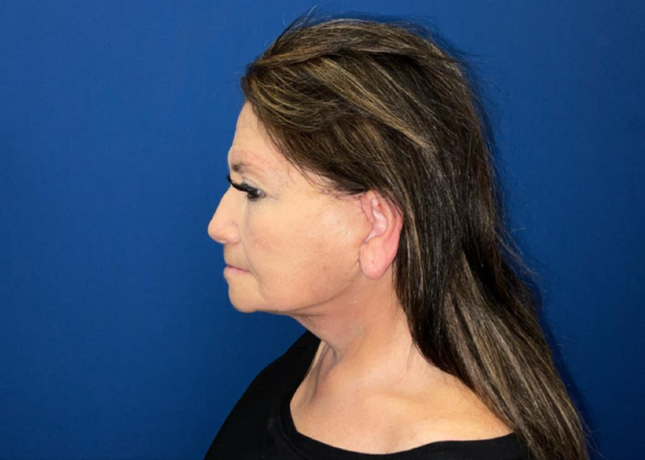 Facelift: Case 4 - Before