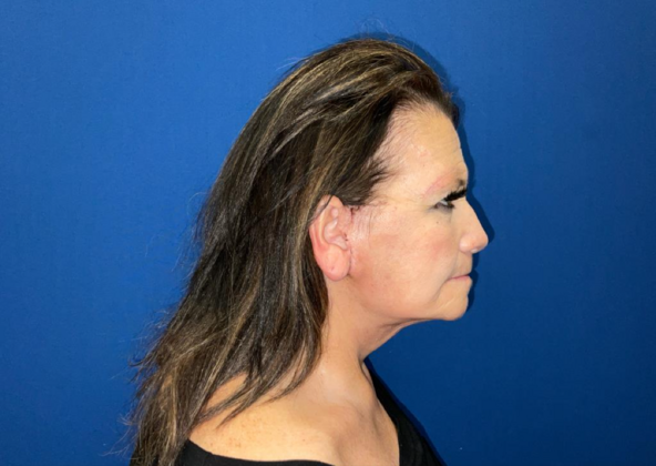 Facelift: Case 4 - After