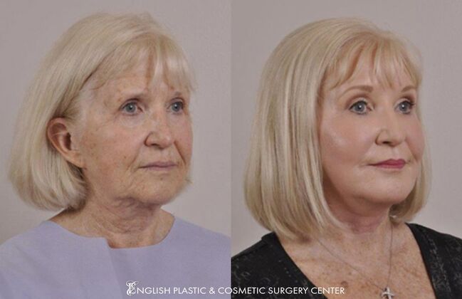 Facial Liposuction: Case 19 - Before & After