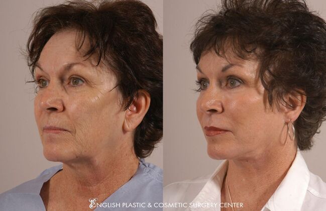 Facial Liposuction: Case 23 - Before & After