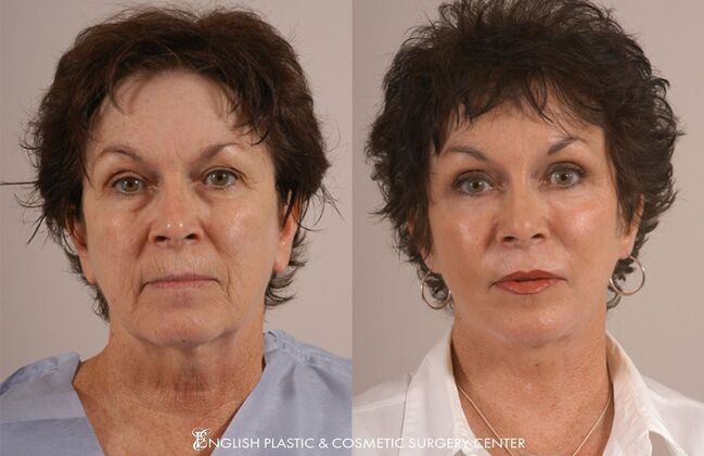 Facial Liposuction: Case 23 - Before & After