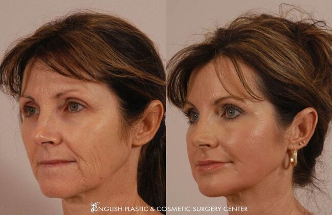 Chin Augmentation/Implant Case 33