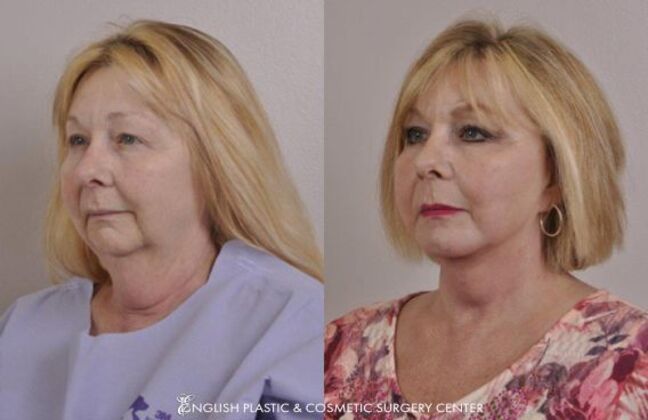 Chin Augmentation/Implant Case 31