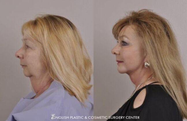 Chin Augmentation/Implant: Case 31 - Before & After