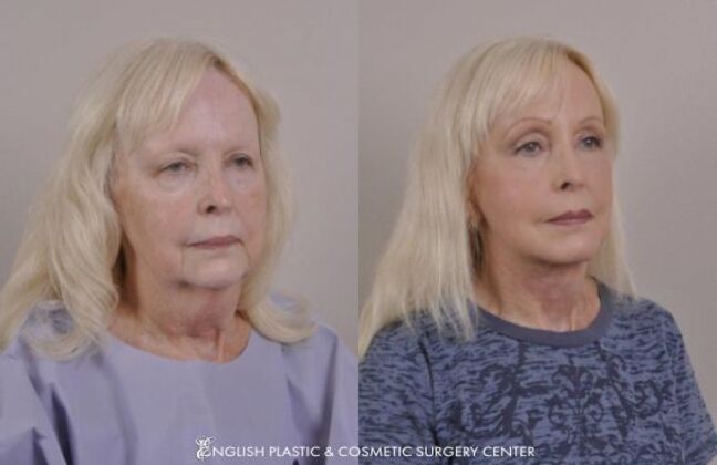 Chin Augmentation/Implant Case 30