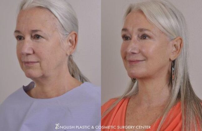 Chin Augmentation/Implant Case 29