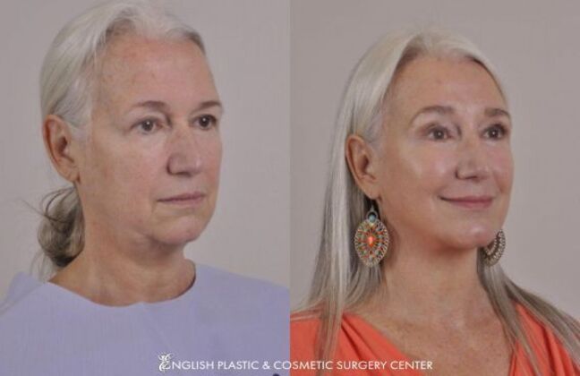Chin Augmentation/Implant: Case 29 - Before & After
