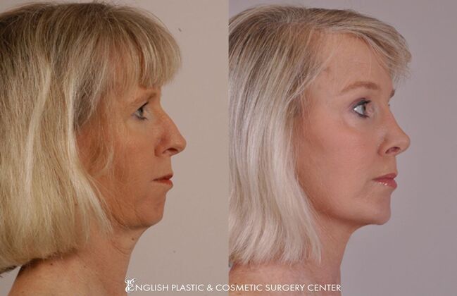 Chin Augmentation/Implant Case 11