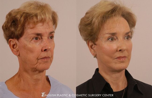 Chin Augmentation/Implant Case 26