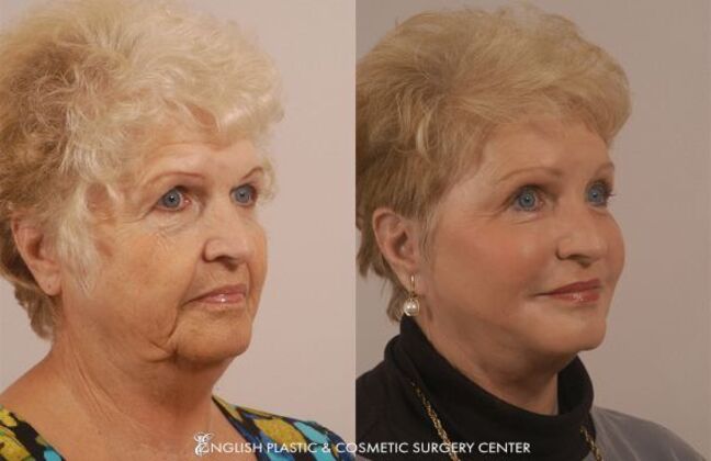 Chin Augmentation/Implant Case 25