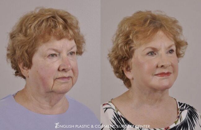 Chin Augmentation/Implant Case 20