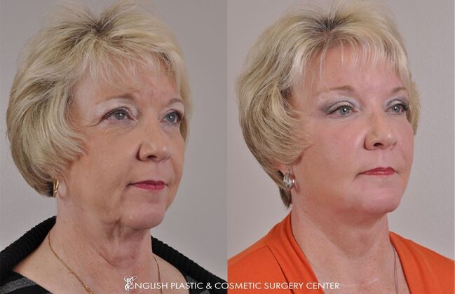 Chin Augmentation/Implant Case 32