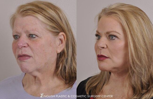 Chin Augmentation/Implant: Case 8 - Before & After