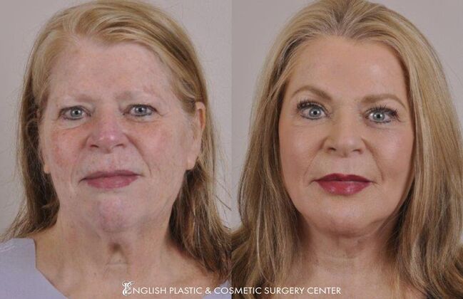 Chin Augmentation/Implant Case 8