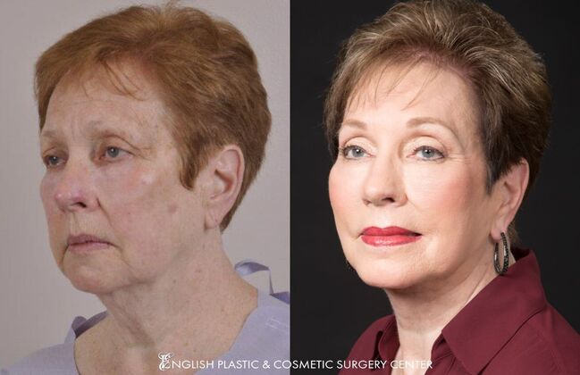 Chin Augmentation/Implant Case 18