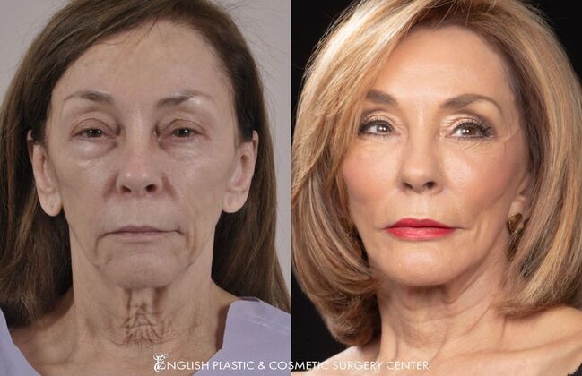 Chin Augmentation/Implant Case 7