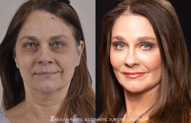 Chin Augmentation/Implant Case 4