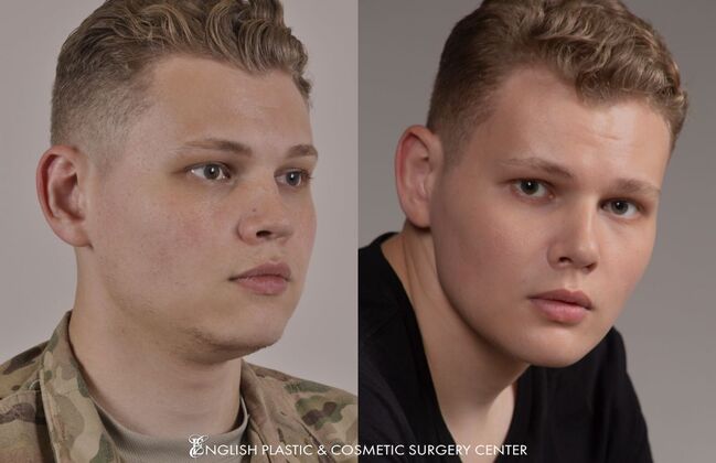 Chin Augmentation/Implant Case 3