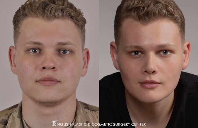 Chin Augmentation/Implant: Case 3 - Before & After