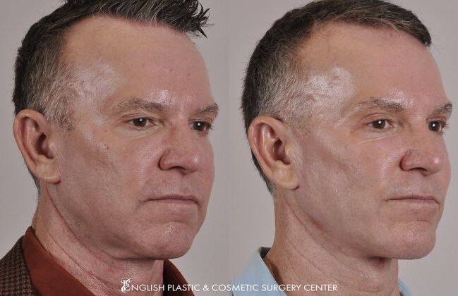 Chin Augmentation/Implant Case 15