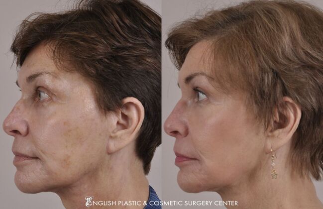 Chin Augmentation/Implant: Case 38 - Before & After