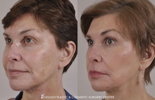 Chin Augmentation/Implant: Case 38 - Before & After