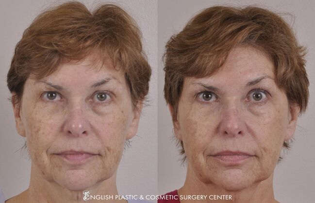 Chin Augmentation/Implant Case 38