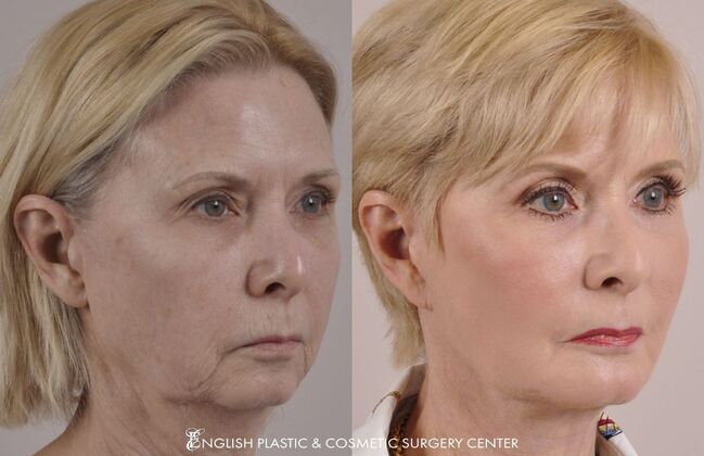 Chin Augmentation/Implant Case 14