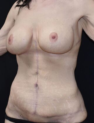 Mommy Makeover: Case 340 - After