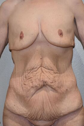 Mommy Makeover Case 340 - Before