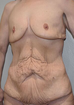 Mommy Makeover: Case 340 - Before