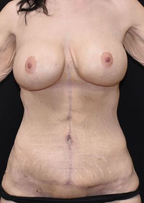 Massive Weight Loss  Case 175 - After