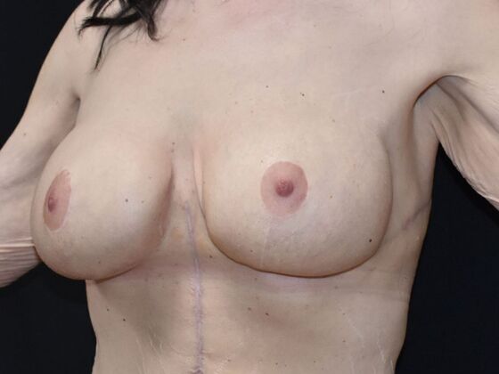 Breast Augmentation w/ Lift: Case 593 - After