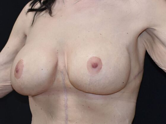 Breast Revision: Case 292 - After