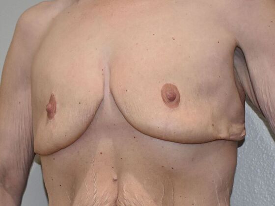 Breast Revision: Case 292 - Before