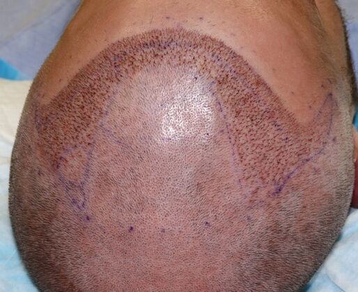 Hair Transplants: Case 11 - Frontal Hairline Restoration with FUE Hair Transplant - Immediately Post op
