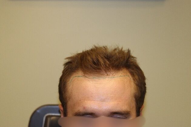 Hair Transplants: Case 11 - Frontal Hairline Restoration with FUE Hair Transplant - Before