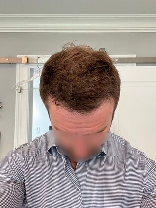 Hair Transplants: Case 11 - Frontal Hairline Restoration with FUE Hair Transplant - After Different Angle
