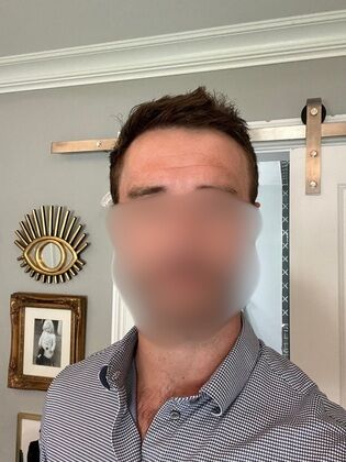 Hair Transplants: Case 11 - Frontal Hairline Restoration with FUE Hair Transplant - After