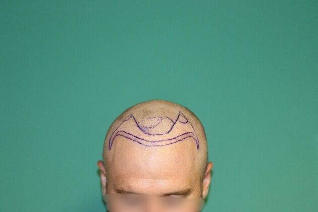 Hair Transplants: Case 11 - Frontal Hairline Restoration with FUE Hair Transplant - Pre Surgical Plan