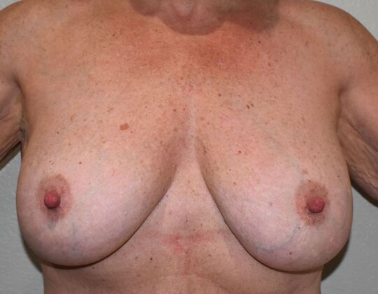 Breast Augmentation w/ Lift Case 596 - Before