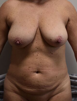 Mommy Makeover Case 341 - Before