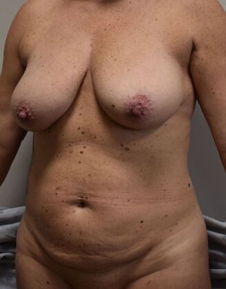 Mommy Makeover: Case 341 - Before