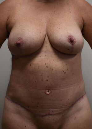 Mommy Makeover Case 341 - After