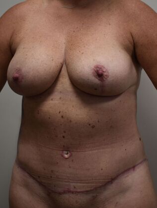 Mommy Makeover: Case 341 - After