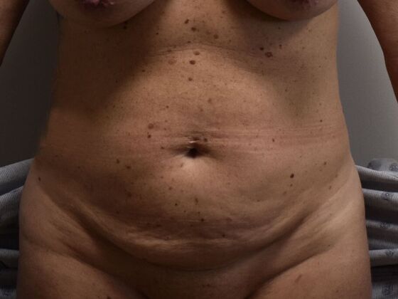 Tummy Tuck (Abdominoplasty) Case 535 - Before