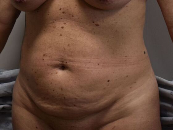 Tummy Tuck (Abdominoplasty): Case 535 - Before