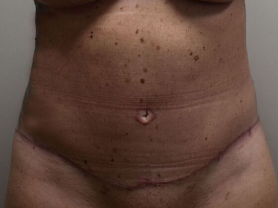 Tummy Tuck (Abdominoplasty) Case 535 - After