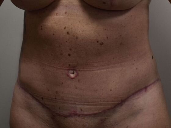Tummy Tuck (Abdominoplasty): Case 535 - After